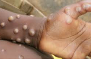 L’OMS alerte sur l’épidémie de mpox qui s’étend en RDC