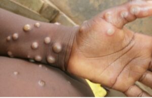 Variole du singe : Le CDC Afrique déclare « une urgence de santé publique »